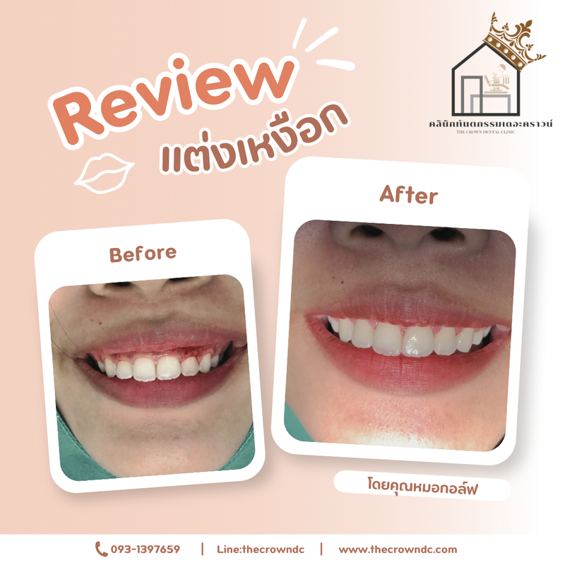 Gum laser l เลเซอร์เหงือก