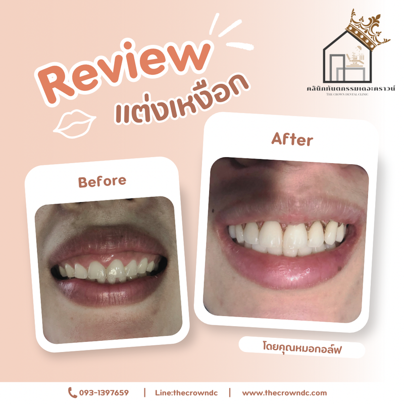 Gum laser l เลเซอร์เหงือก