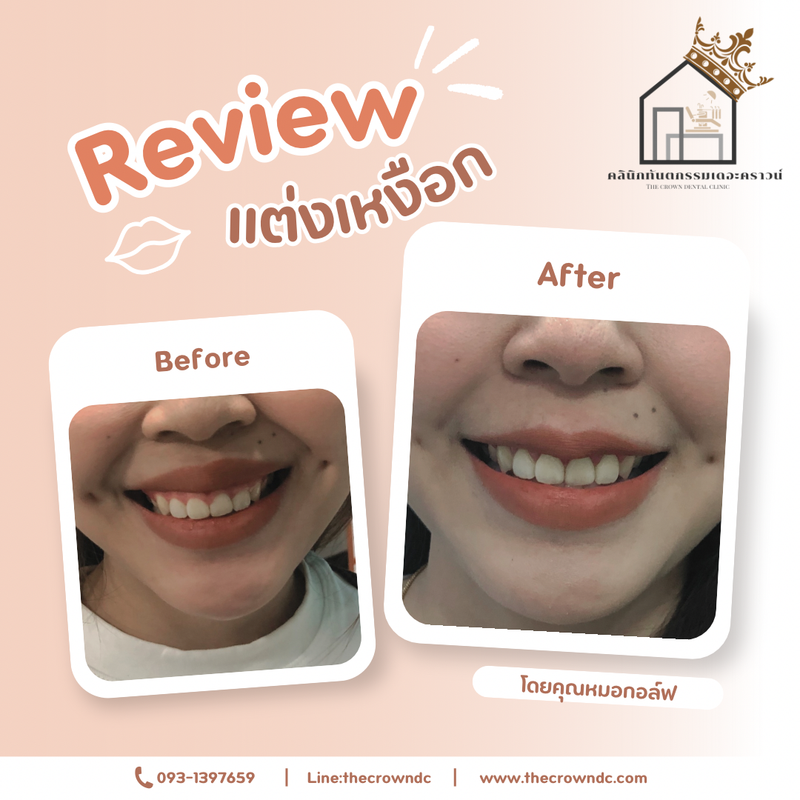 Gum laser l เลเซอร์เหงือก