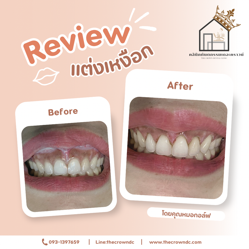 Gum laser l เลเซอร์เหงือก