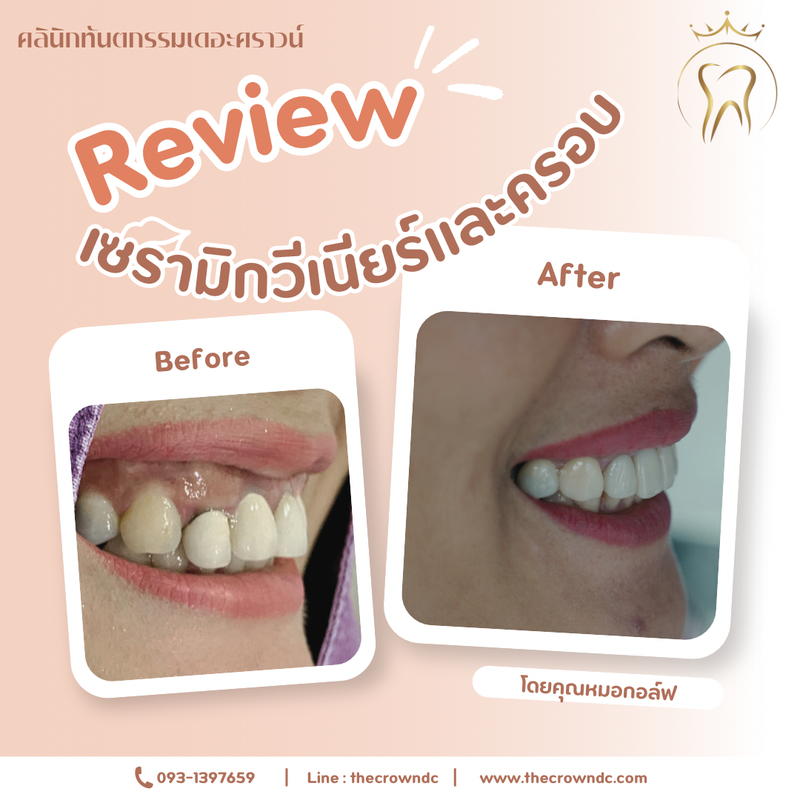 Ceramic veneers | เซรามิกวีเนียร์