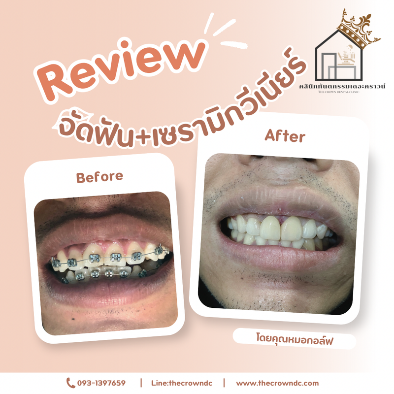 Ceramic veneers | เซรามิกวีเนียร์