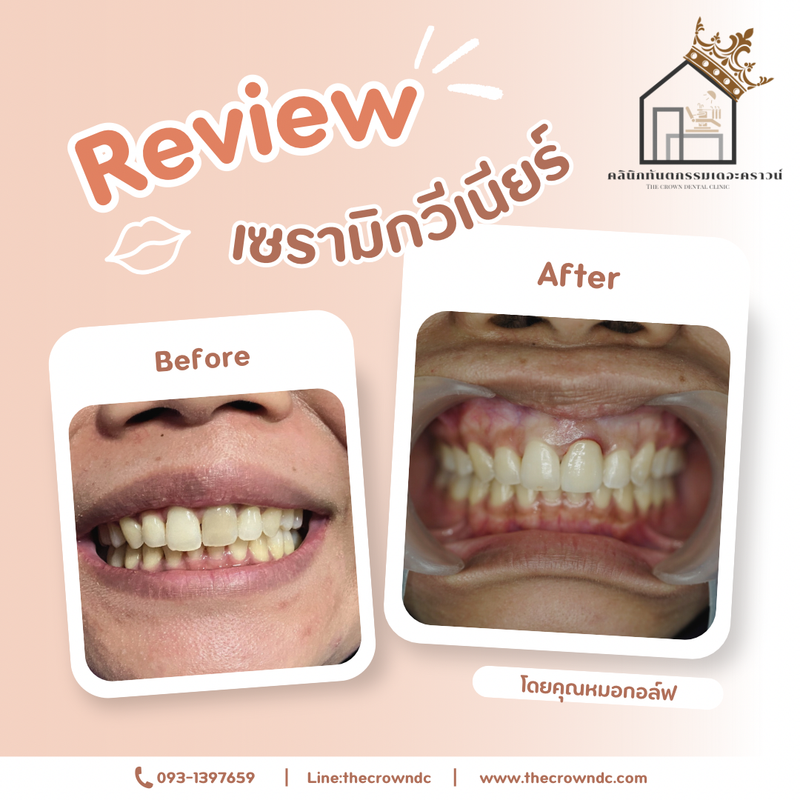 Ceramic veneers | เซรามิกวีเนียร์