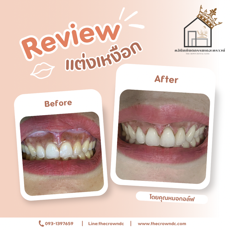 Gum laser l เลเซอร์เหงือก