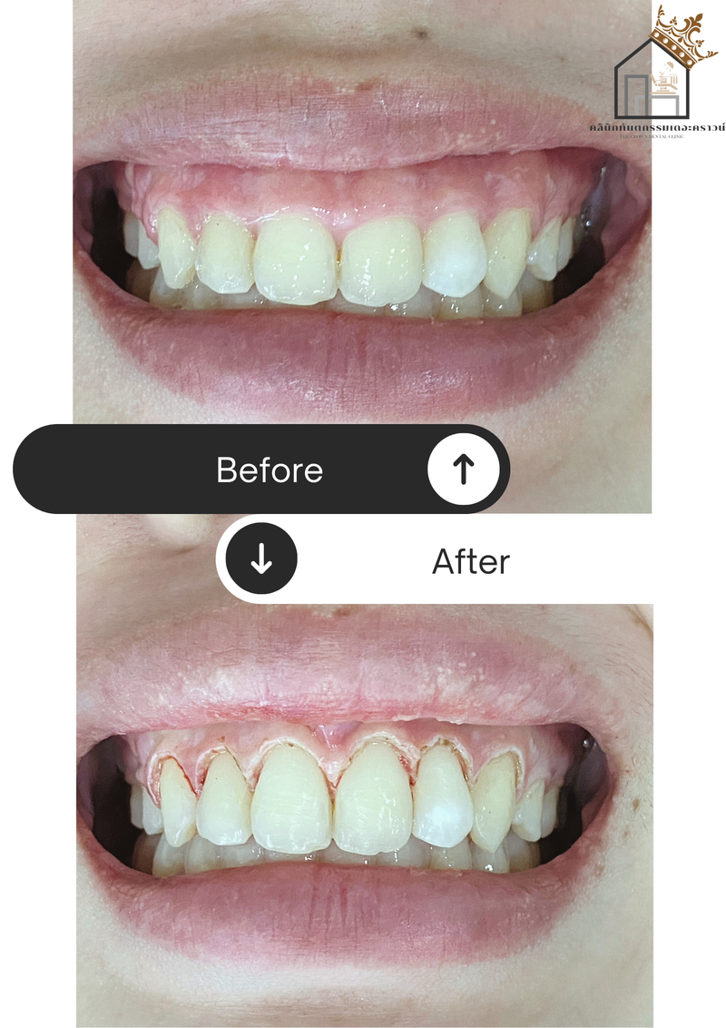 Gum laser l เลเซอร์เหงือก