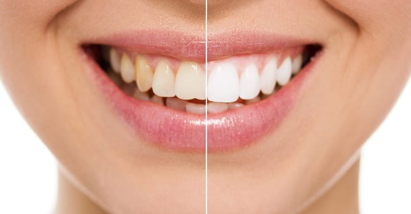 Diş Beyazlatma/Teeth Whitening