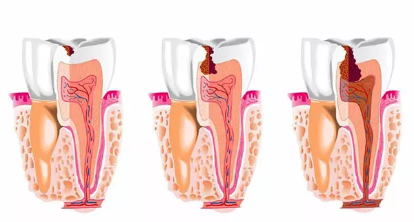 Kanal Tedavisi/Root Canal Operation