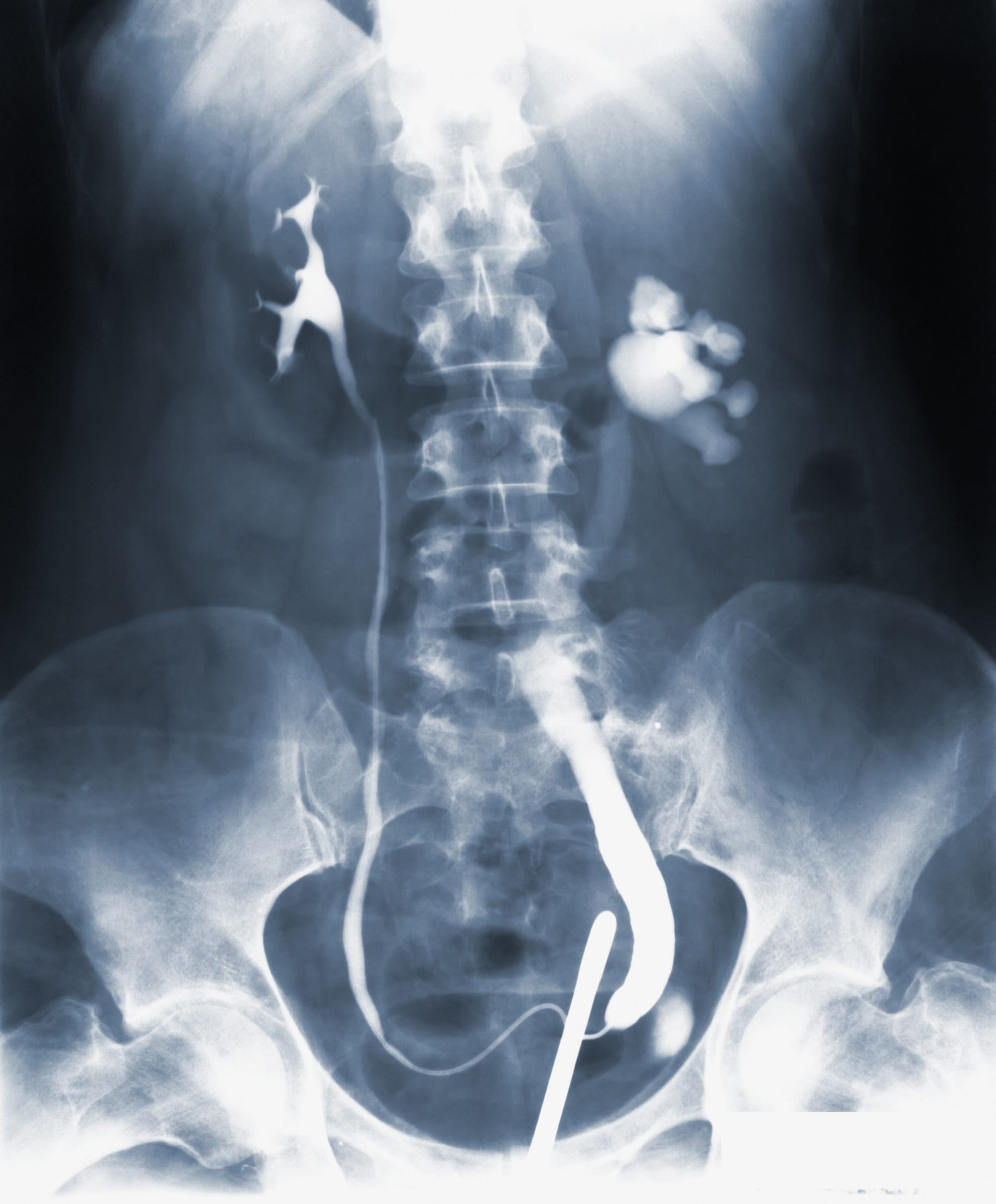 Transvaginal ultrasonography versus hysteroscopy in endometrial pathology diagnosis among women with abnormal uterine bleeding