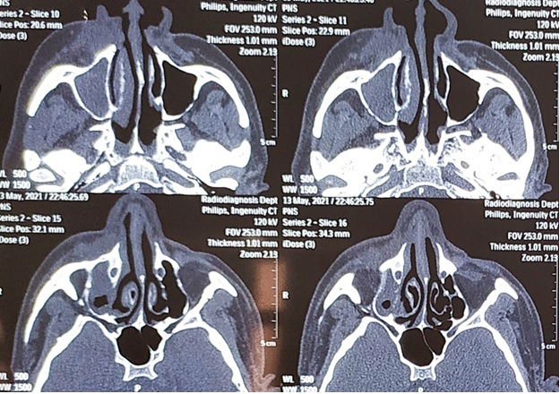 Bain’s circuit as continuous positive airway pressure device in a postoperative COVID-19 associated mucormycosis patient with type-1 respiratory failure: a case report