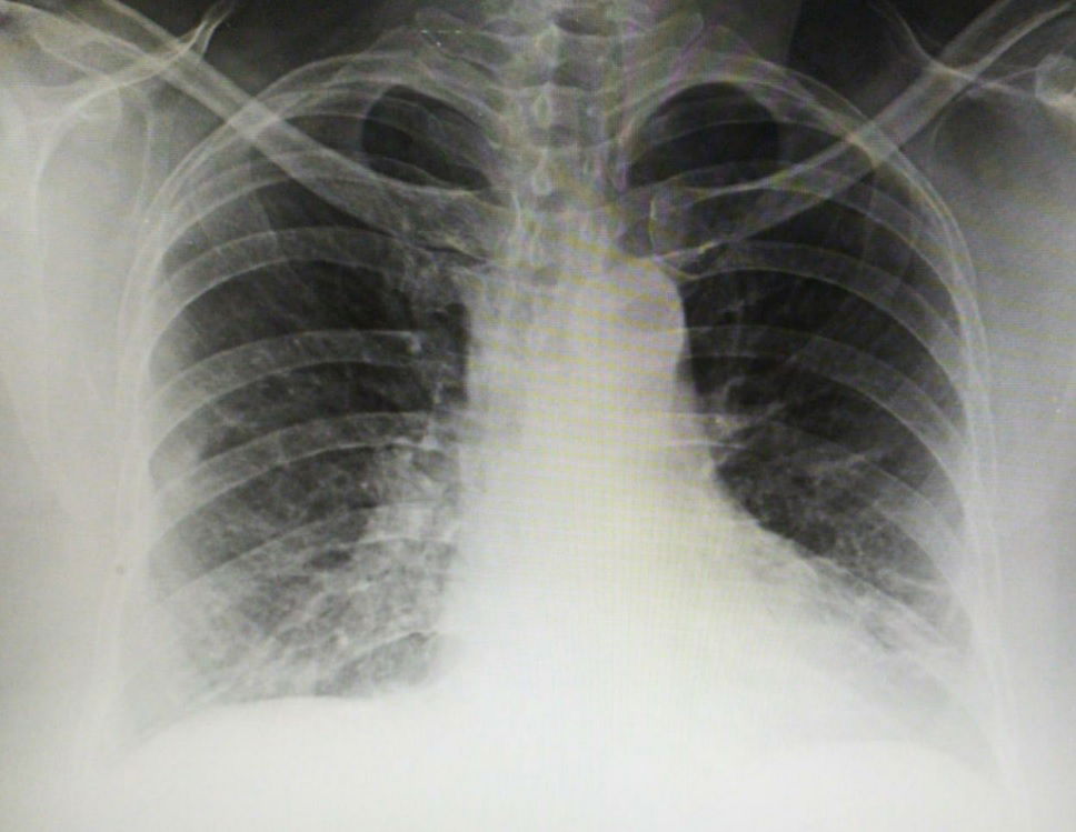 Role of Chest Imaging in Diagnosis and Management of COVID-19