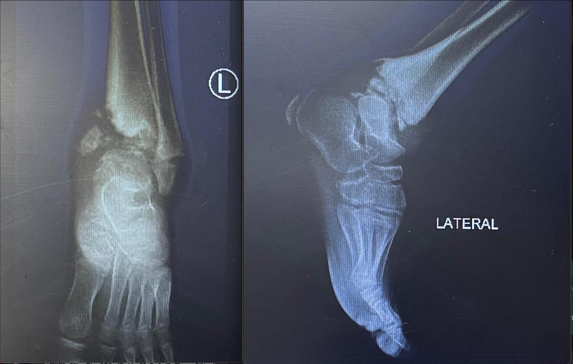 NGF Mutation Associated with Hereditary Sensory and Autonomic Type V and Orthopedic Aspects