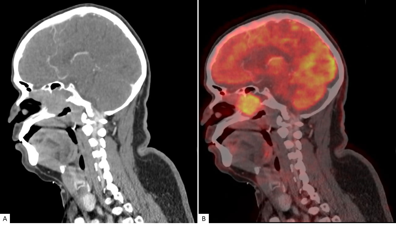 Dedifferentiated Liposarcoma of the Nasopharynx - A Case Report of a Rare Enigmatic Entity