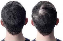 زراعة الشعر