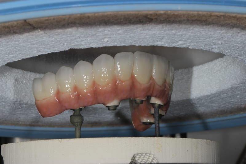 full arch over implant