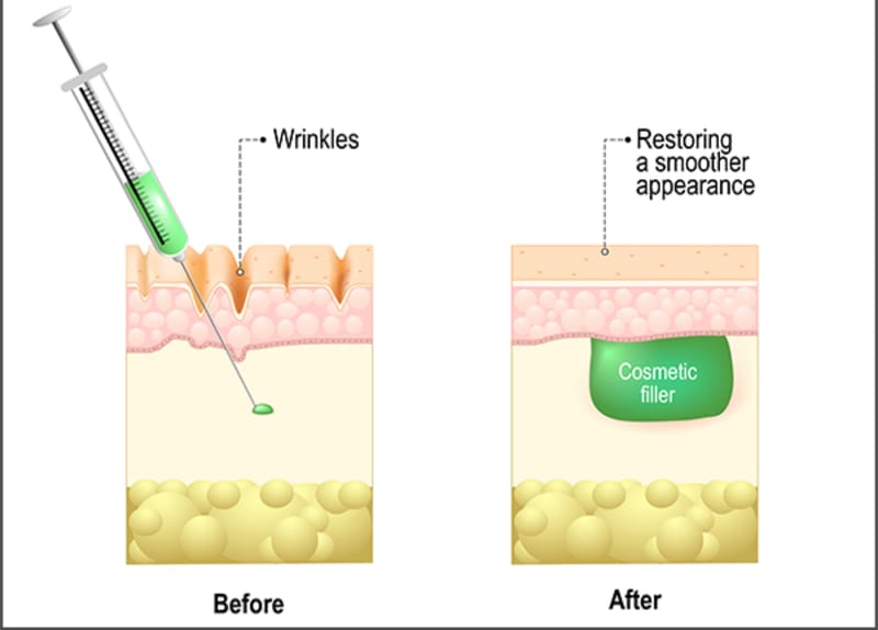 Derma Fillers