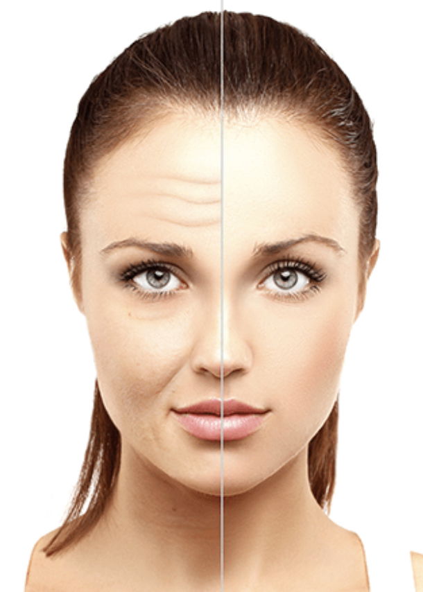 Anti-Wrinkle injections