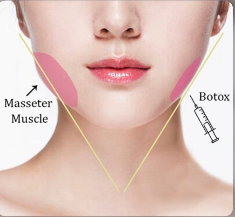 Jaw slimming Botox®