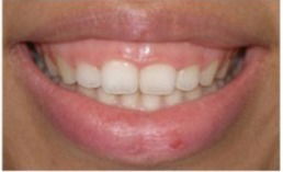Gummy smile