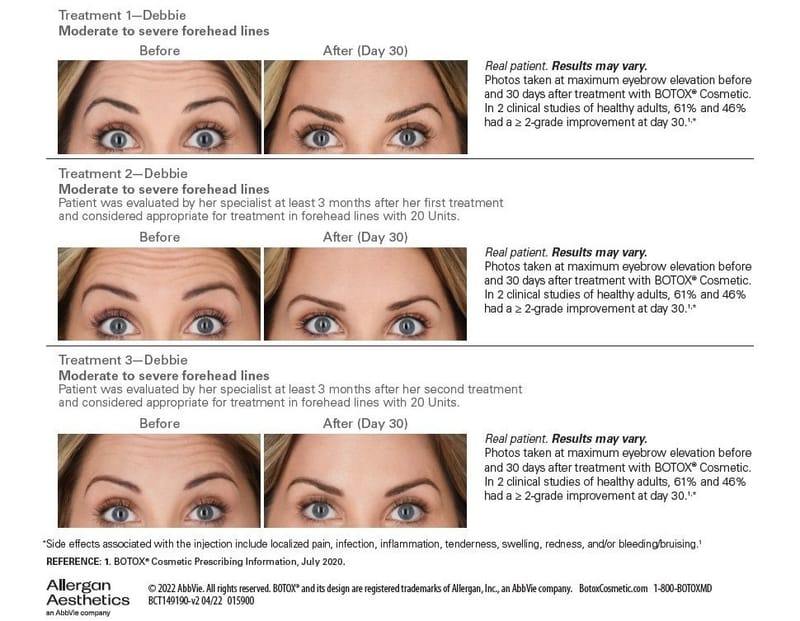 Wrinkle Reducing Injections