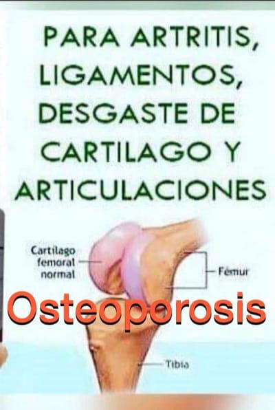 Artritis, Artrosis, Osteoporosis