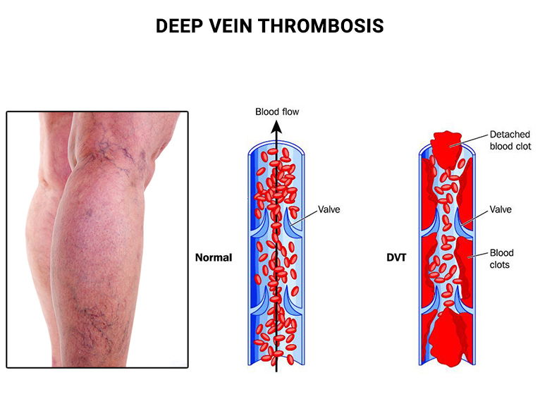 HOME REMEDIES FOR BLOOD CLOTS