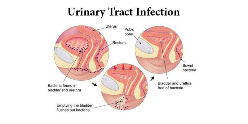 Keepers at Home-Urinary Tract Infection