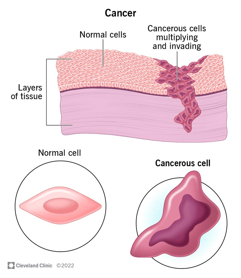 CANCER AND ITS HOME REMEDIES