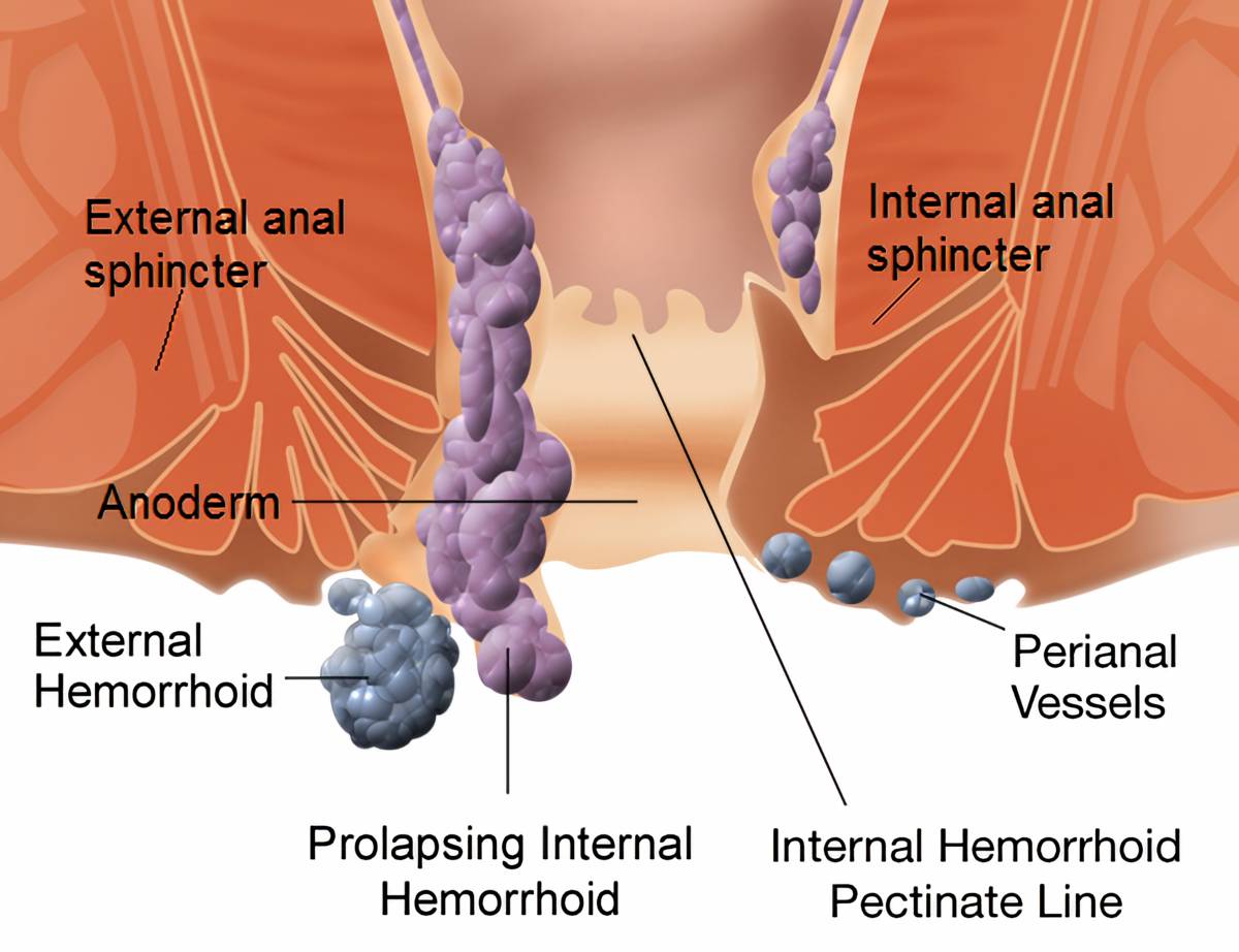 HOME REMEDIES FOR HEMORRHOIDS/EMROIDS