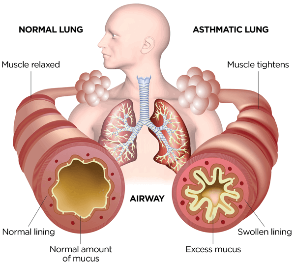 HOME REMEDIES FOR ASTHMA