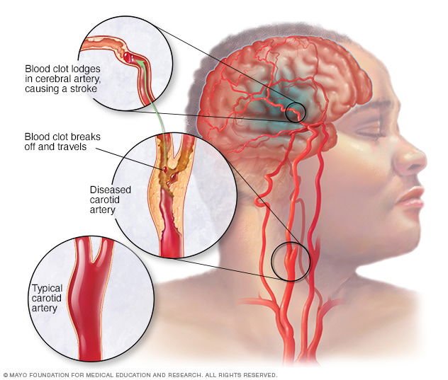 HOME REMEDIES FOR STROKE