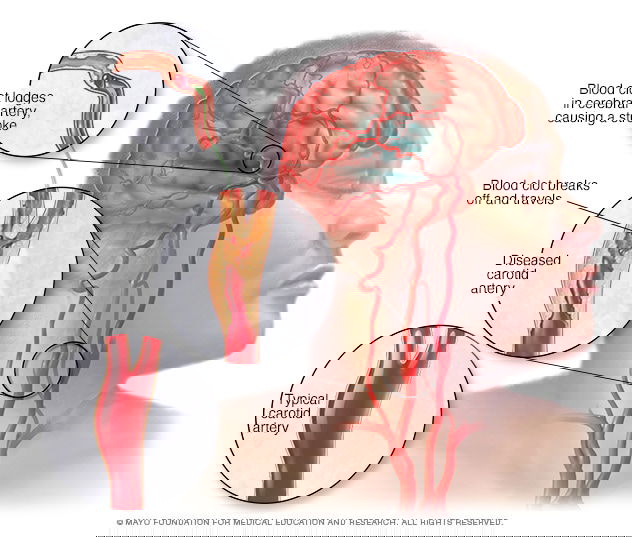 HOME REMEDIES FOR STROKE