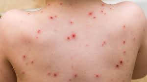 El Ministerio de Salud Pública (MSP) reporta tres casos adicionales de viruela del mono en Ecuador