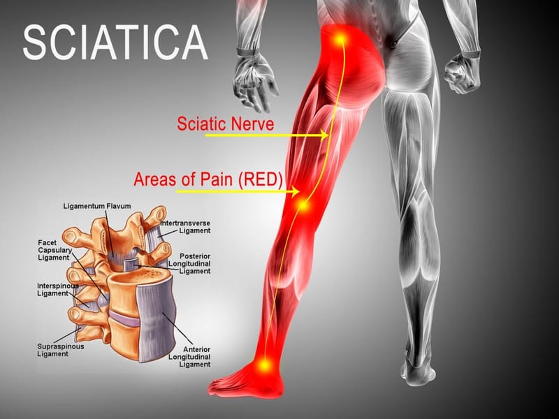 Sciatica Pain