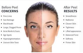 CONSULTATION for BioRePeel MEDICAL SKIN PEEL