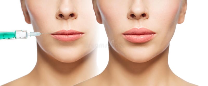 LIP DISSOLVE (Corrections)