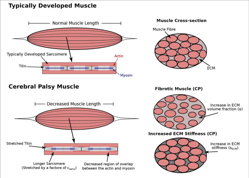 «Μυς και Εγκεφαλική Παράλυση»