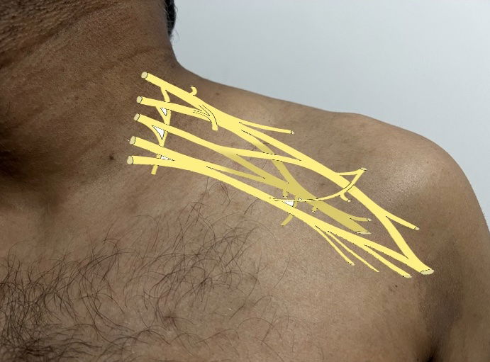 Brachial plexus injuries