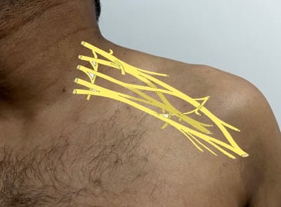 Brachial plexus injuries