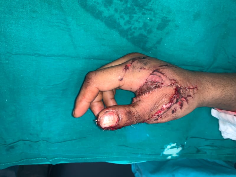 Hand Surgery