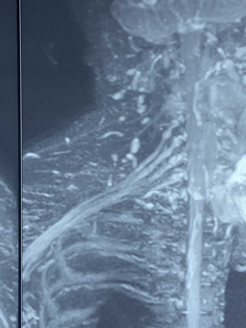 Peripheral nerve surgery