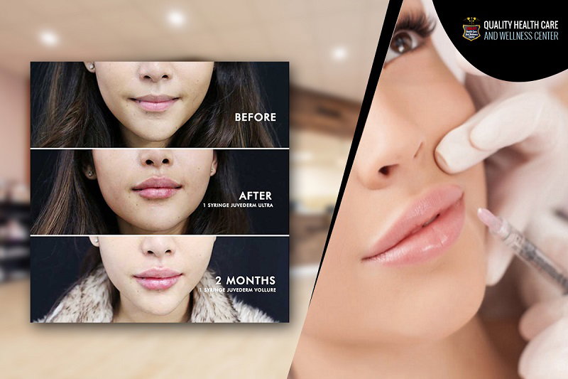 JUVEDERM TREATMENT