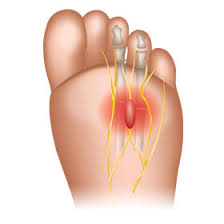 Morton's Neuroma