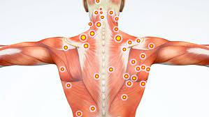 Myofasciaal Pijnsyndroom