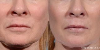 Morpheus 8 RF Microneedling