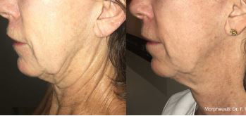 Morpheus 8 RF Microneedling