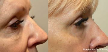 Morpheus 8 RF Microneedling