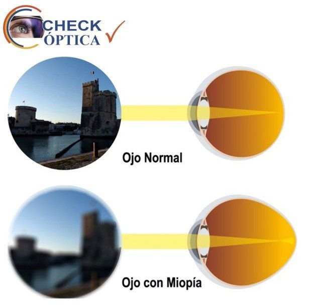 MIOPÍA