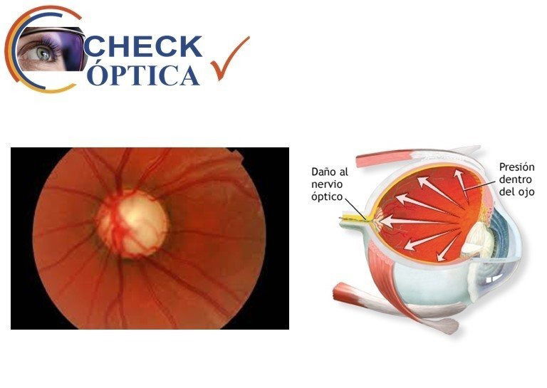 ¿Qué es el glaucoma?