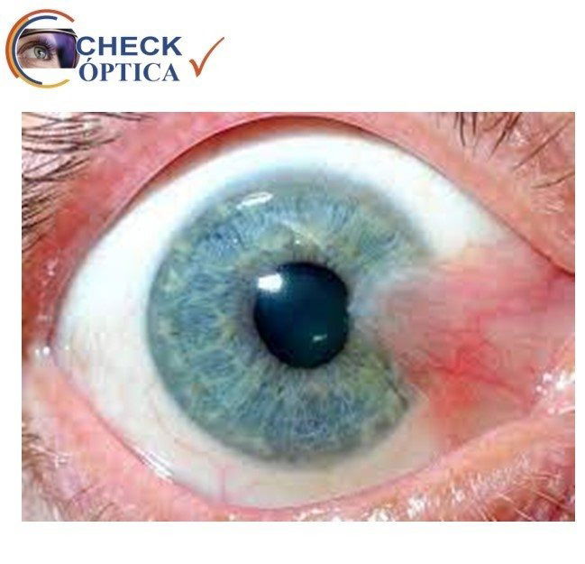 ¿Qué es el Pterigium?