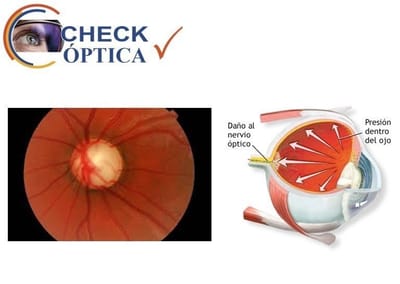 ¿Qué es el glaucoma?
